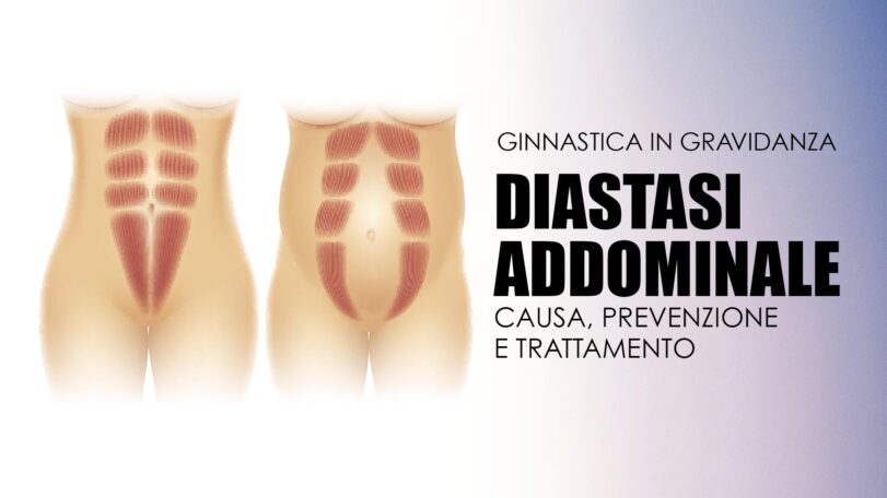 Diastasi addominale: causa, prevenzione e trattamento